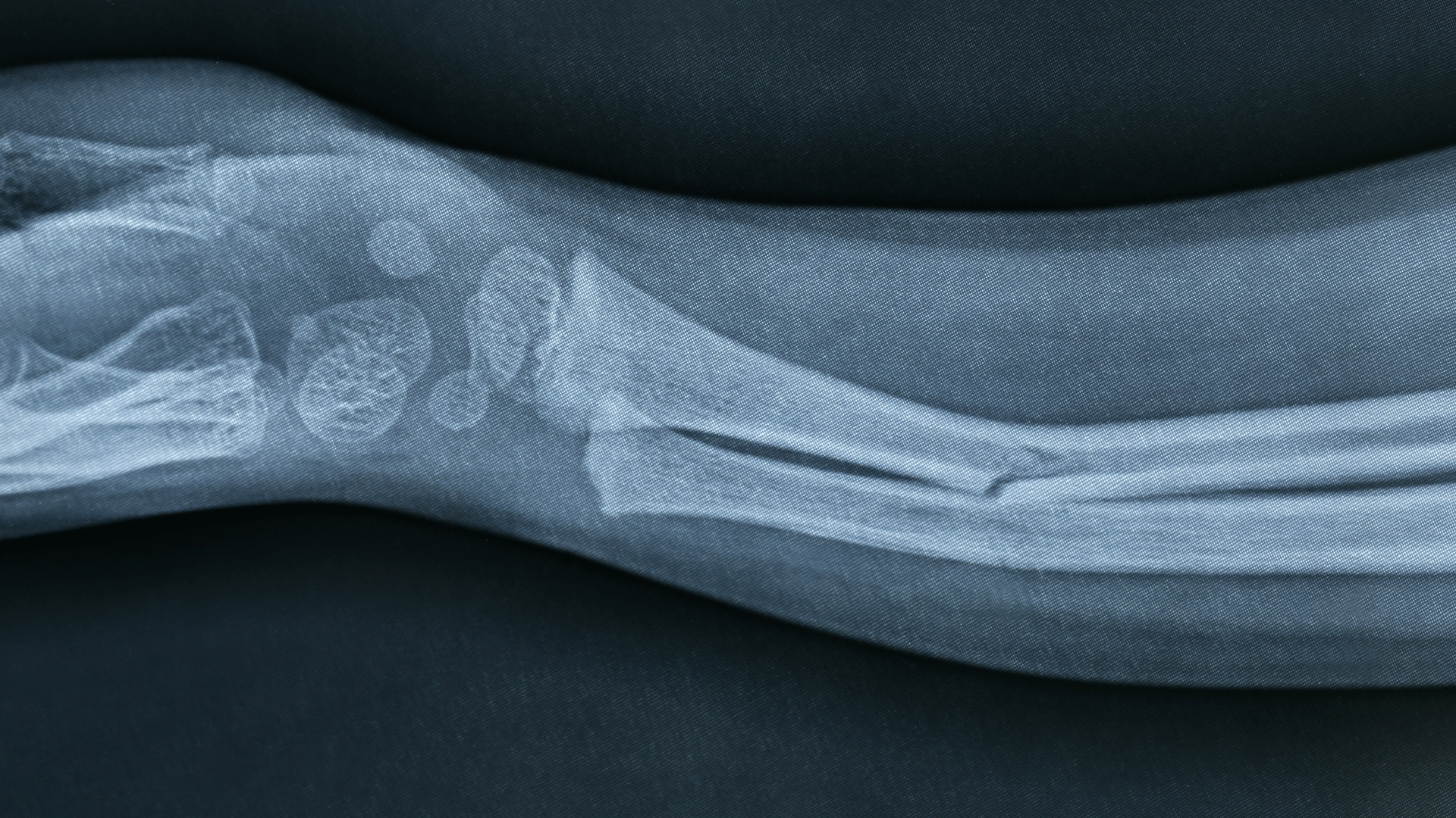 X-ray of a broken arm. Photo: Colourbox
